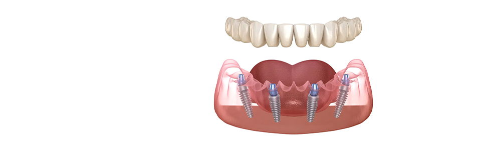 Dental Implants Results