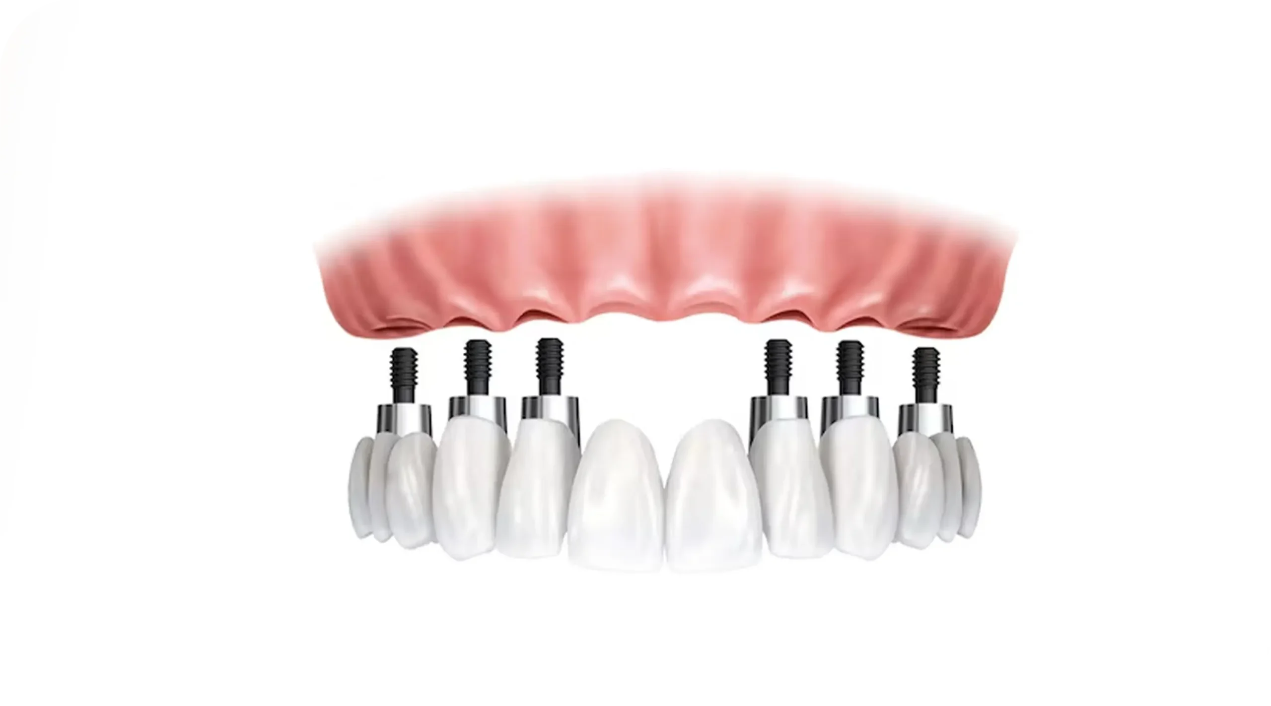 All-on-6 Implants