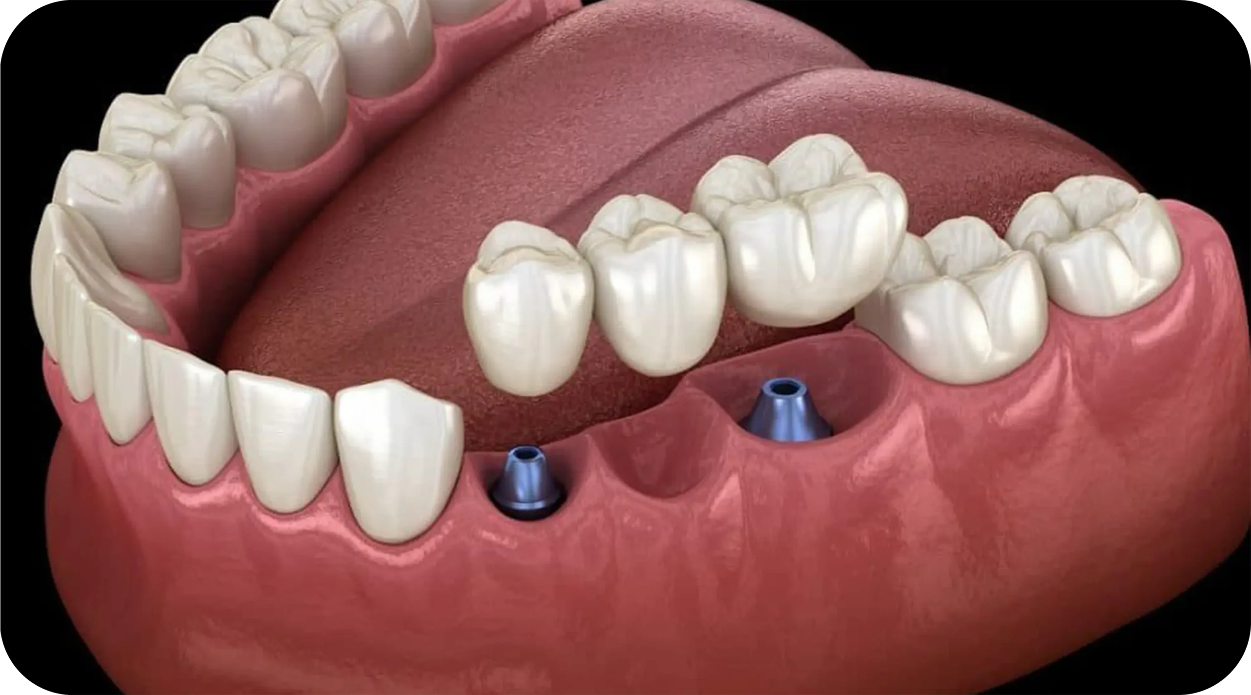 Implant Supported Bridge