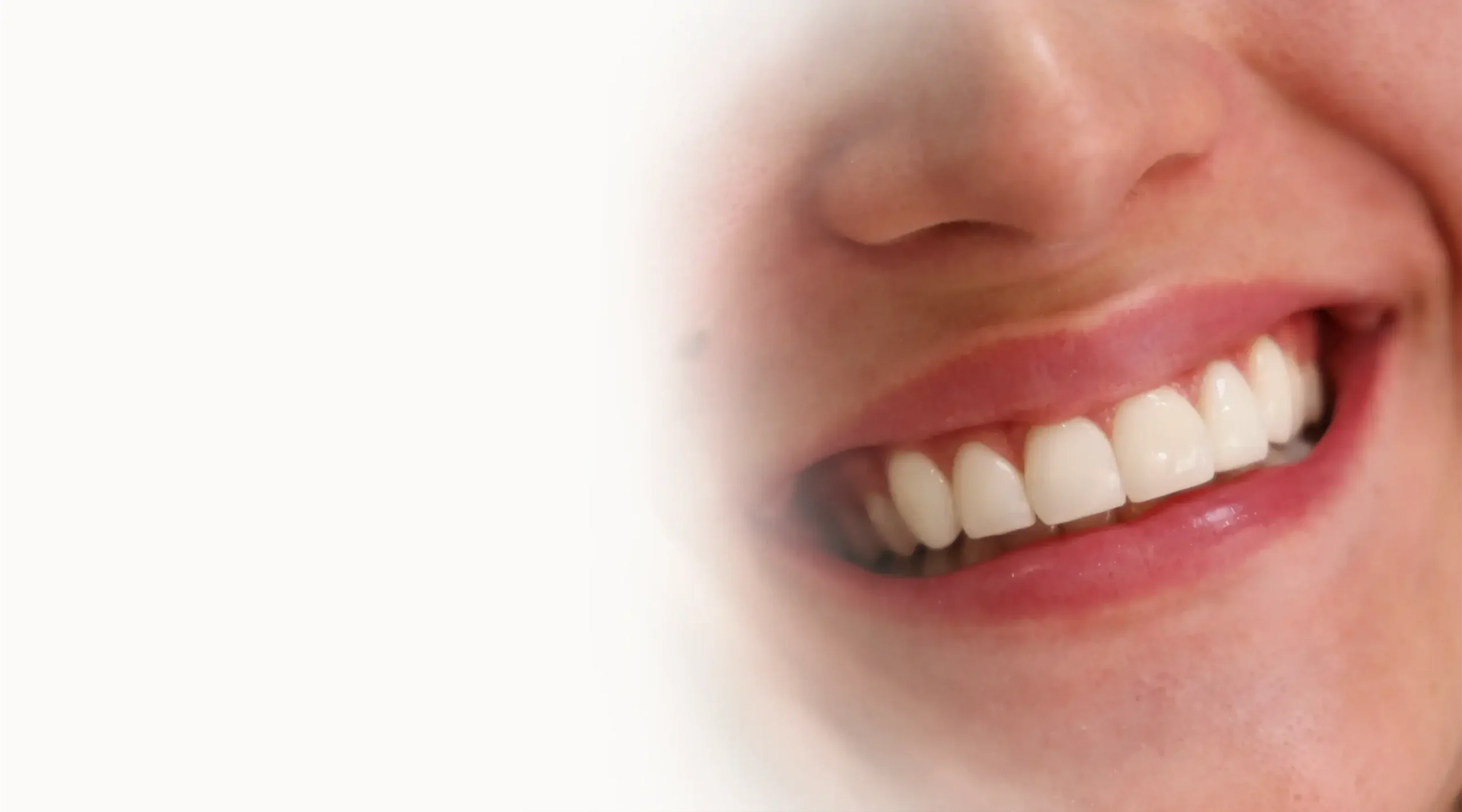 Composite Veneers