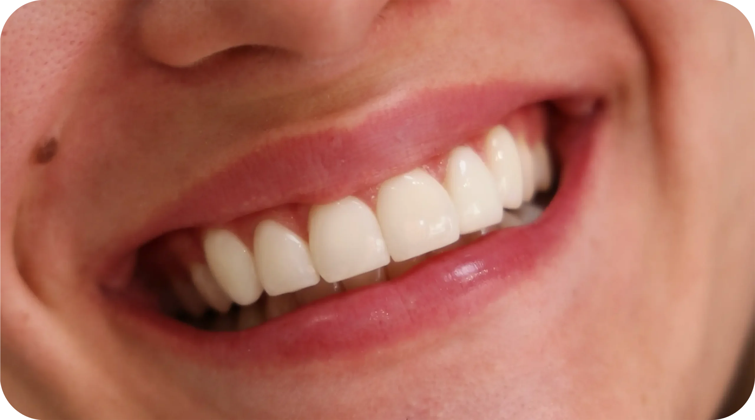 Composite Veneers