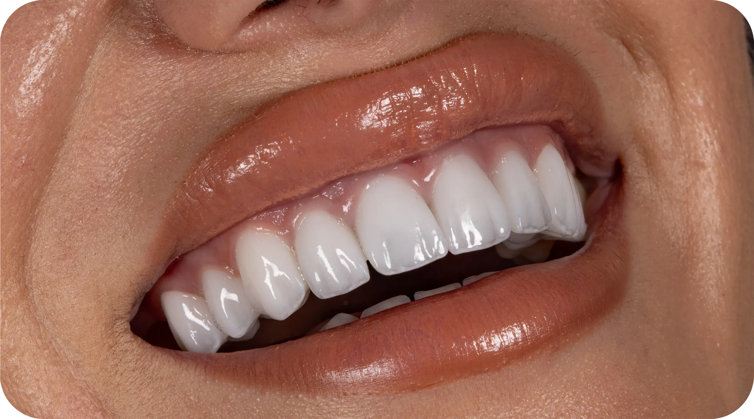 e.max Veneers