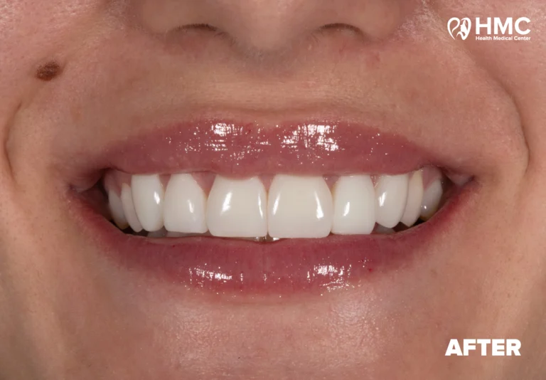 After: Composite Bonding Smile Makeover - Full Smile