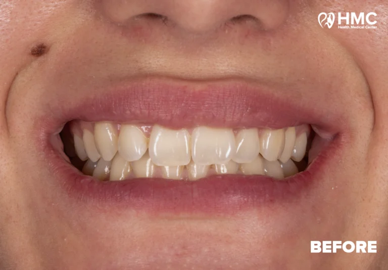 Before: Composite Bonding Smile Makeover - Full Smile