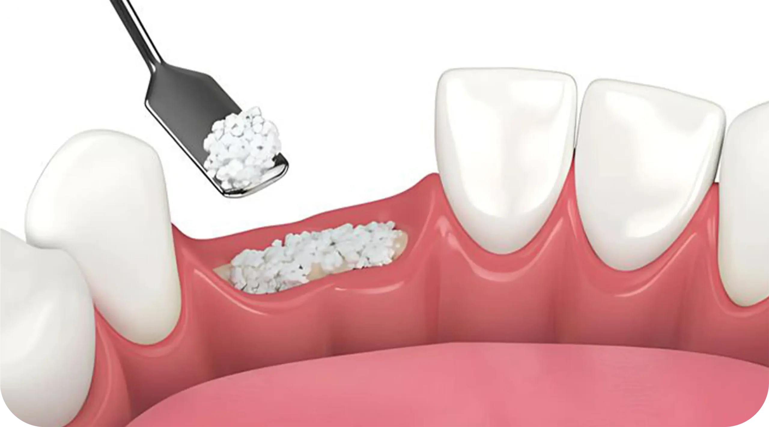 Bone Grafting