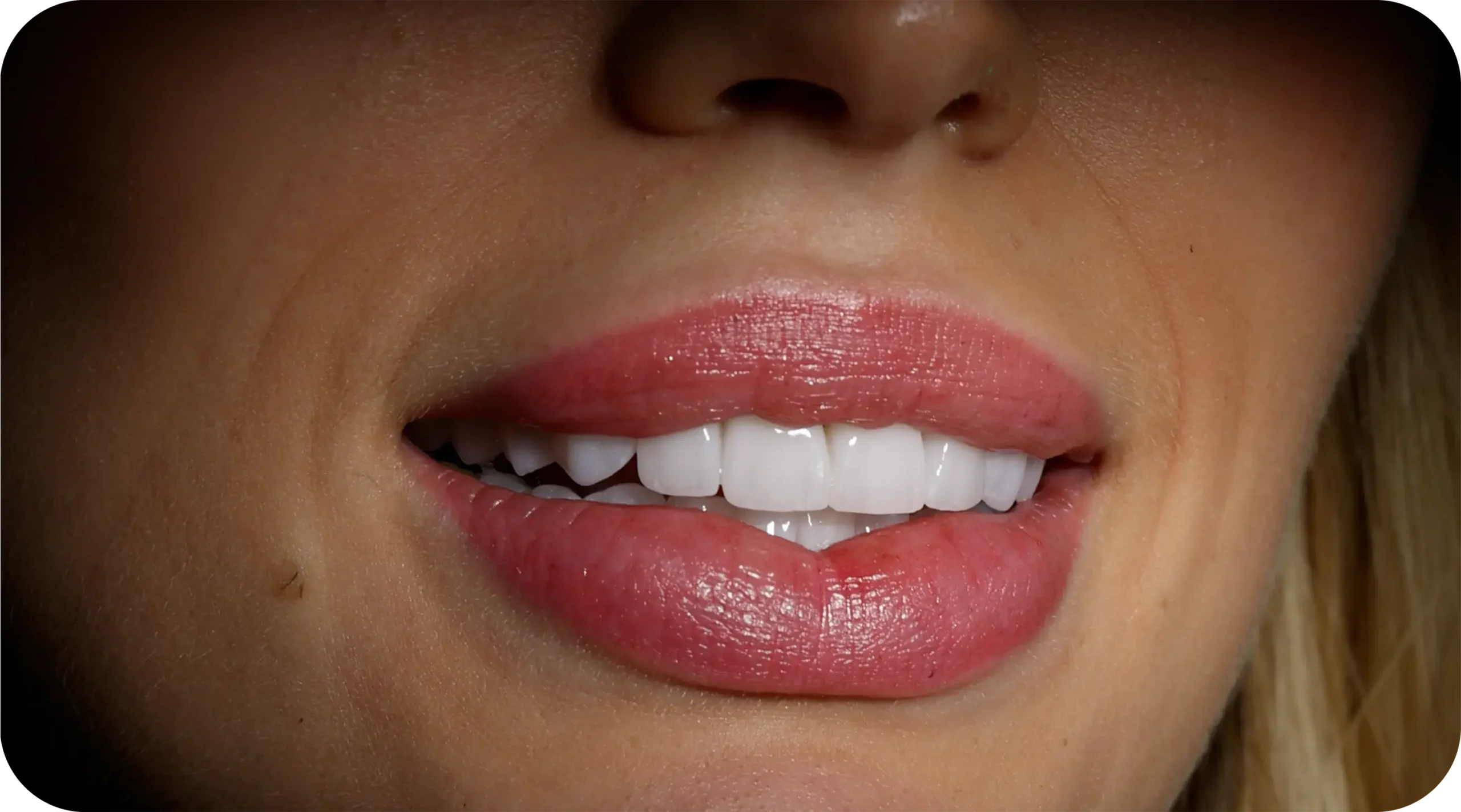 Hollywood Smile