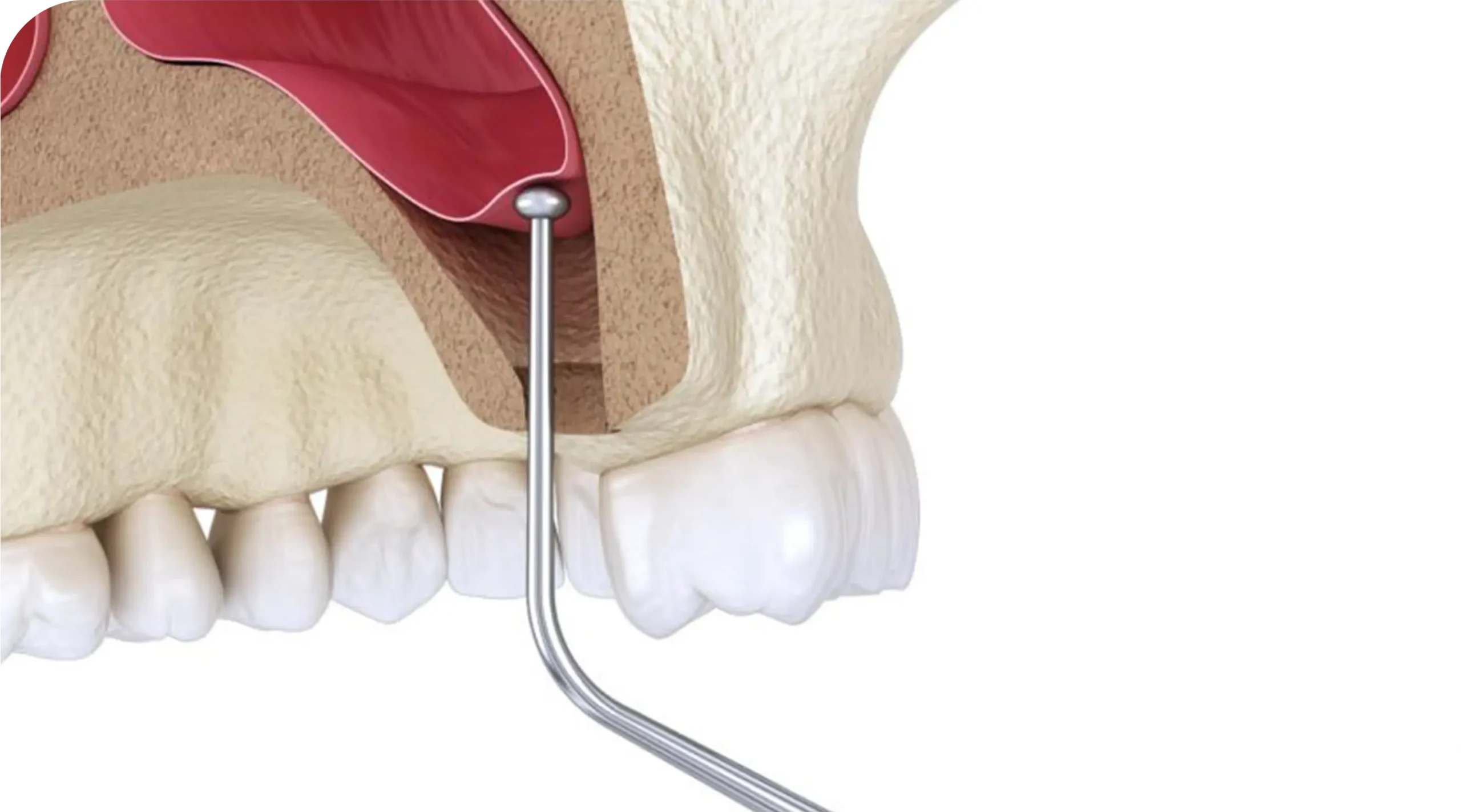 Sinus Lift