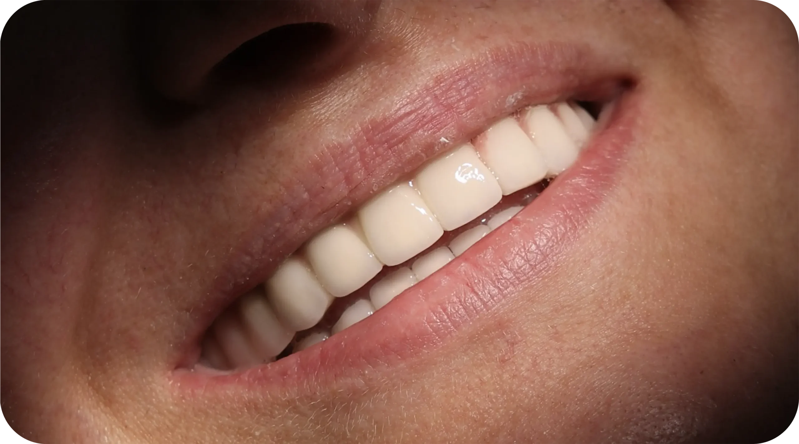 Porcelain-Metal Crowns