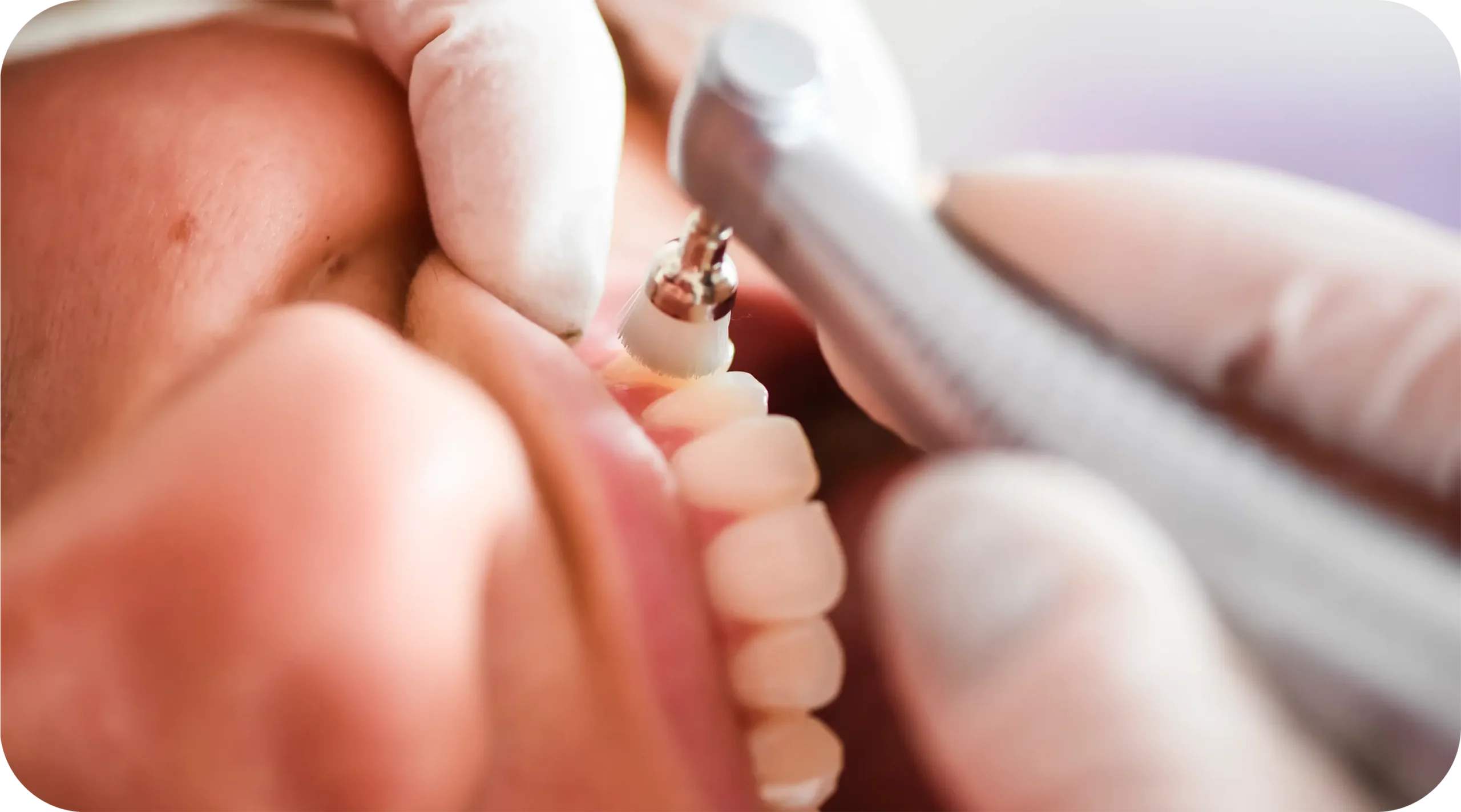 Teeth Cleaning