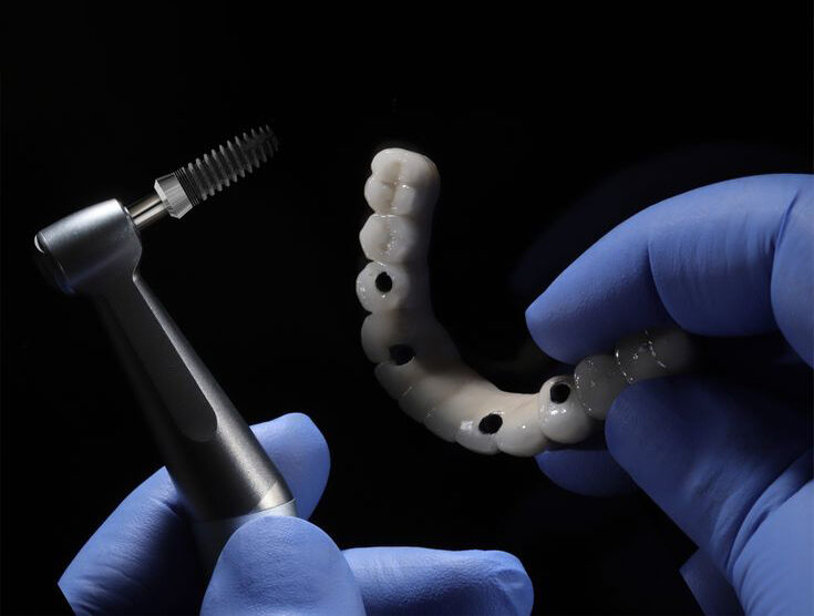 All-on-4 implants at HMC Tirana, Albania