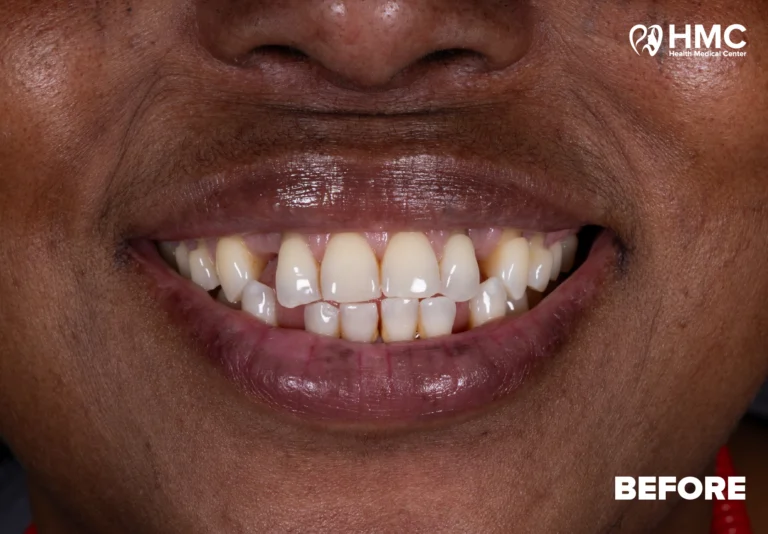 Before: Zirconia Crowns - Straight-on Smile View