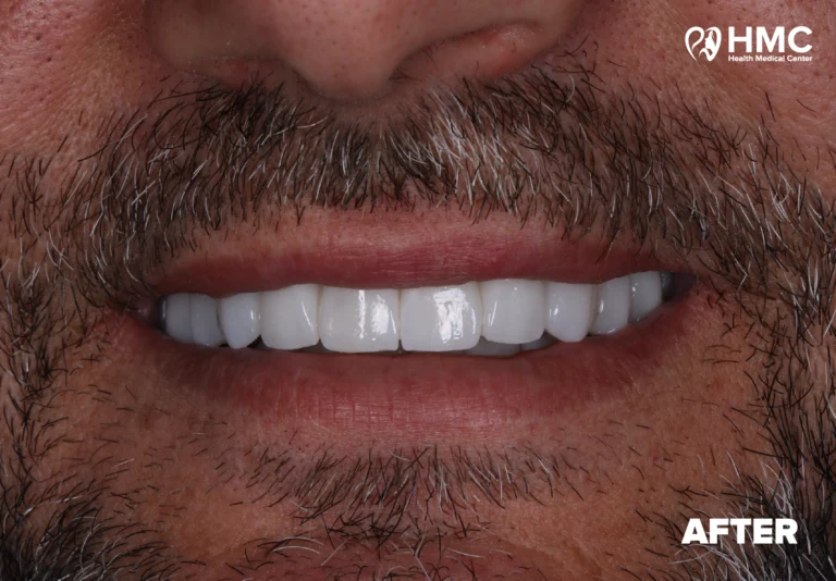 After: Zirconia Crown Treatment - Complete Smile View