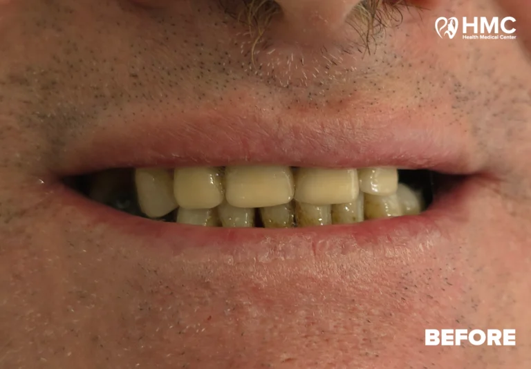 Before: Dental Smile Transformation - All-on-4