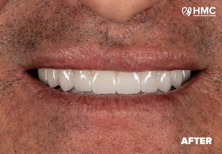 After: Dental Smile Transformation - All-on-4