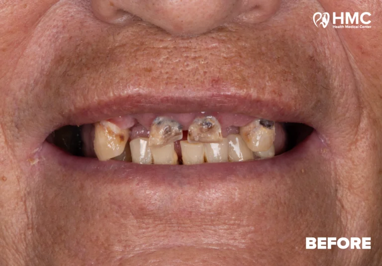Before: Smile Revitalization - All-on-6