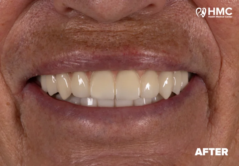 After: Smile Revitalization - All-on-6