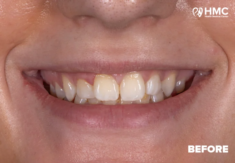 Before: Enhanced Smile with Composite Bonding