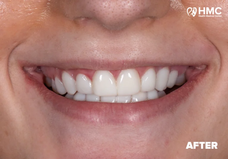 After: Enhanced Smile with Composite Bonding