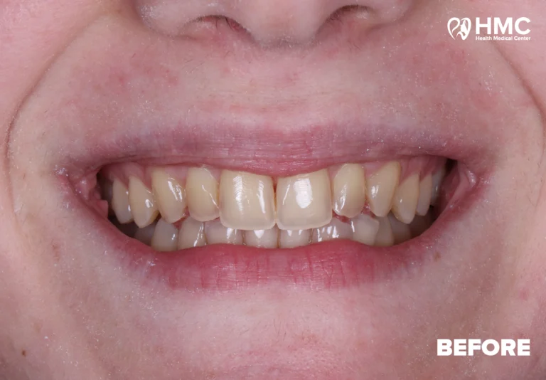 Before: Transformed Smile with Composite Bonding