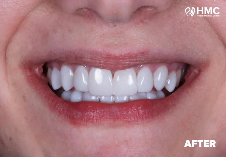 After: Transformed Smile with Composite Bonding