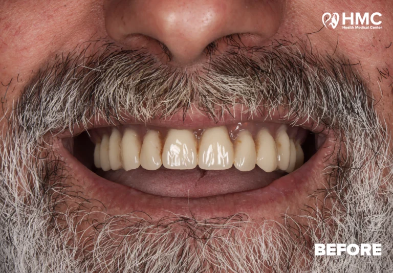 Before: Enhanced Smile with All-on-4