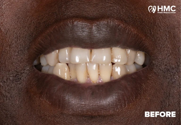 Before: Dental Smile Makeover - Zirconia Crowns