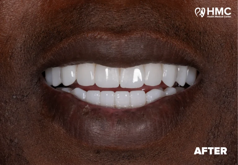 Dopo: Restyling dentale del sorriso — Corone in zirconia
