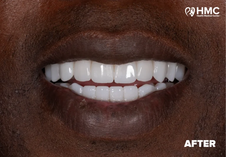 After: Dental Smile Makeover - Zirconia Crowns
