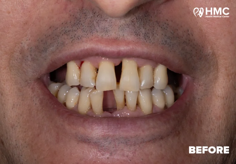 Before: Complete Dental Makeover - Zirconia Crowns