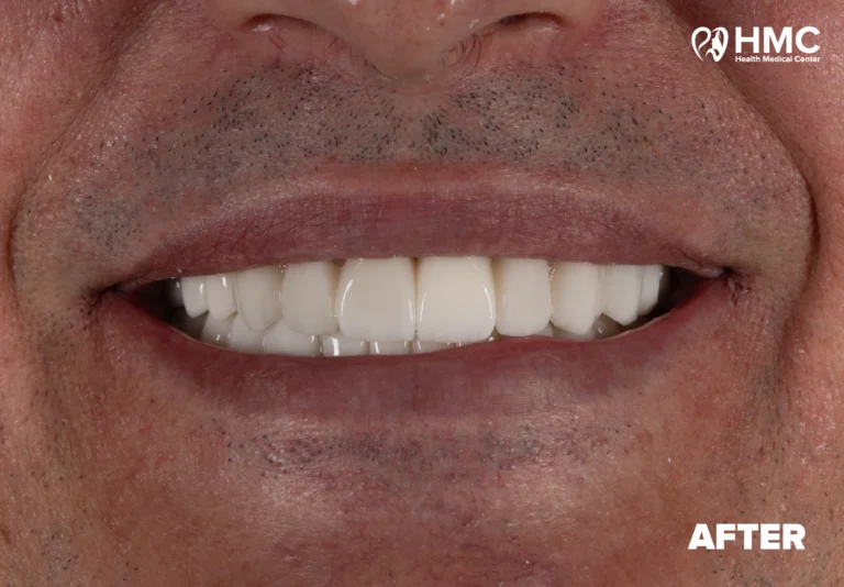 After: Complete Dental Makeover - Zirconia Crowns