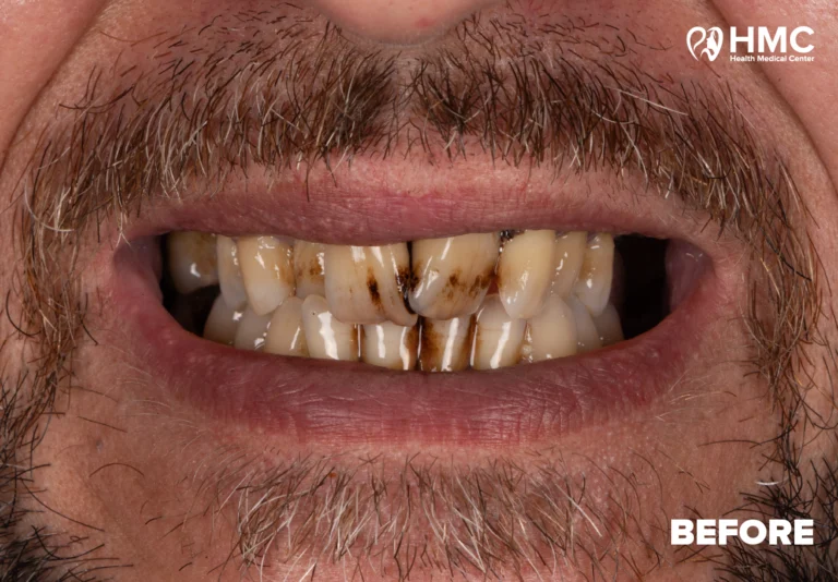 Before: Redesigned Smile - Zirconia Crowns