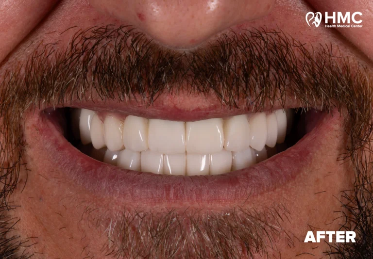 After: Redesigned Smile - Zirconia Crowns
