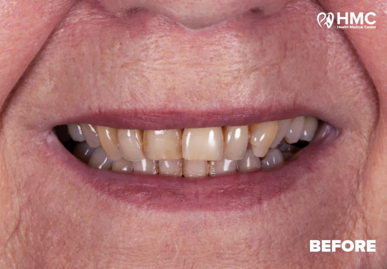 Before: Enhanced Smile with Hollywood Smile Treatment