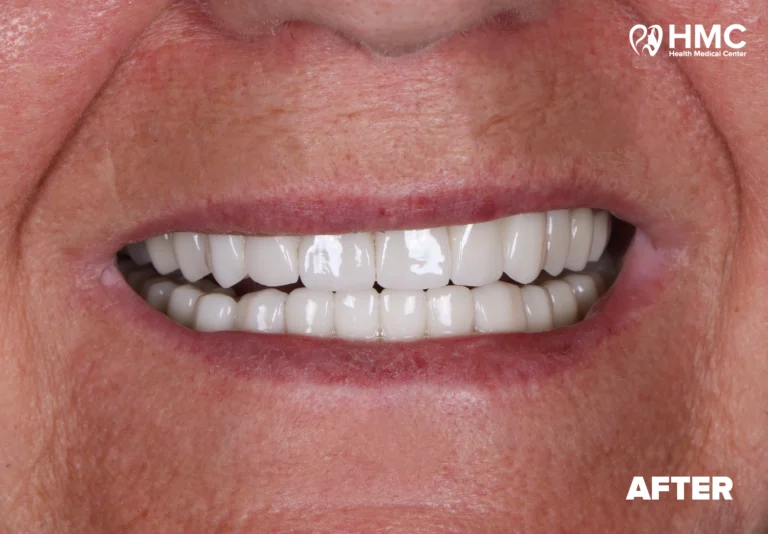 After: Enhanced Smile with Hollywood Smile Treatment
