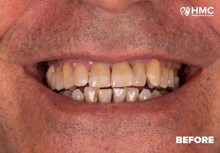 Before: Transformed Smile with All-on-6