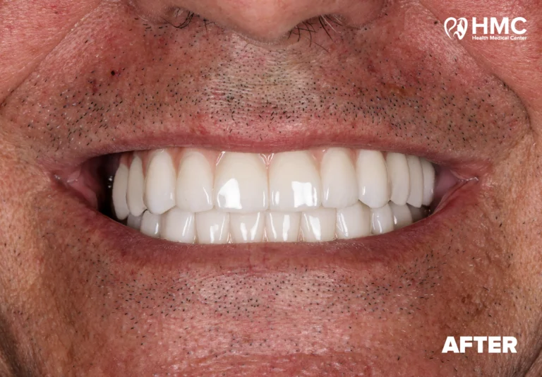 After: Transformed Smile with All-on-6