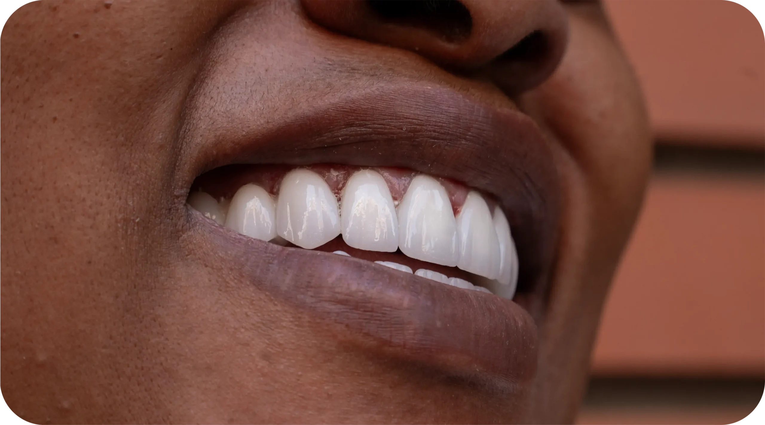 Zirconia Crowns