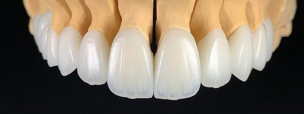 Veneers vs. Crowns: What Is Actually the Difference?