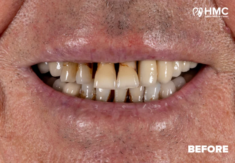 Before: Redesigned Smile with All-on-6