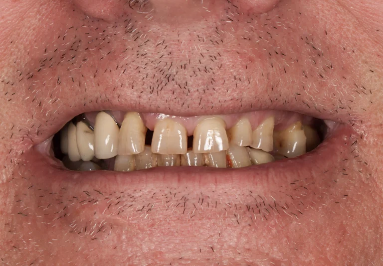 Before: Natural-Looking Smile with All-on-4