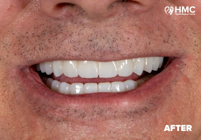 After: Natural-Looking Smile with All-on-4