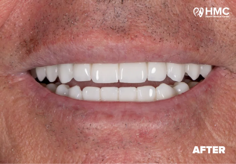 After: Redesigned Smile with All-on-6