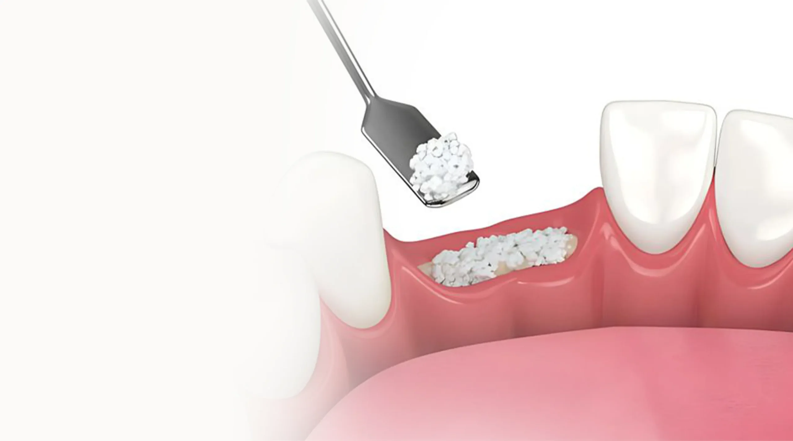 Bone Grafting