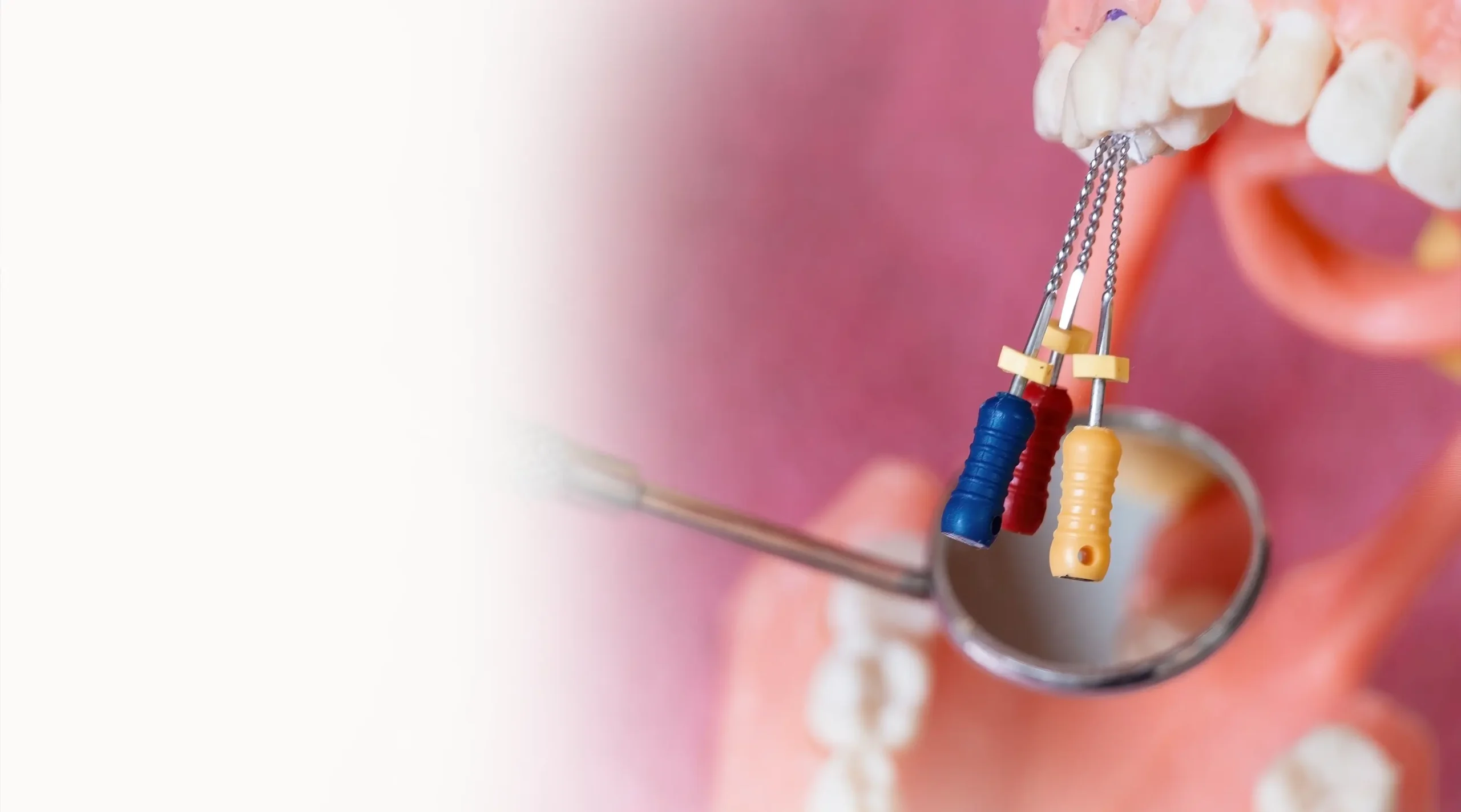 Tratamiento de Conducto (Endodoncia)