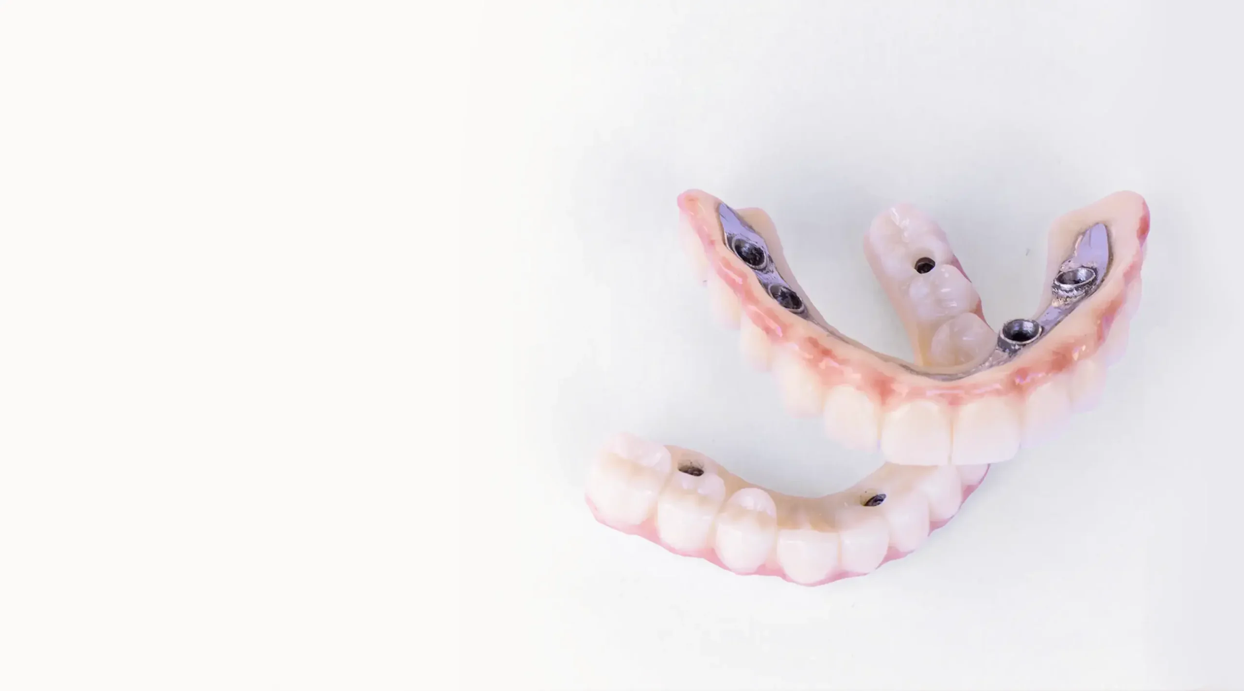 All-on-4 Implants