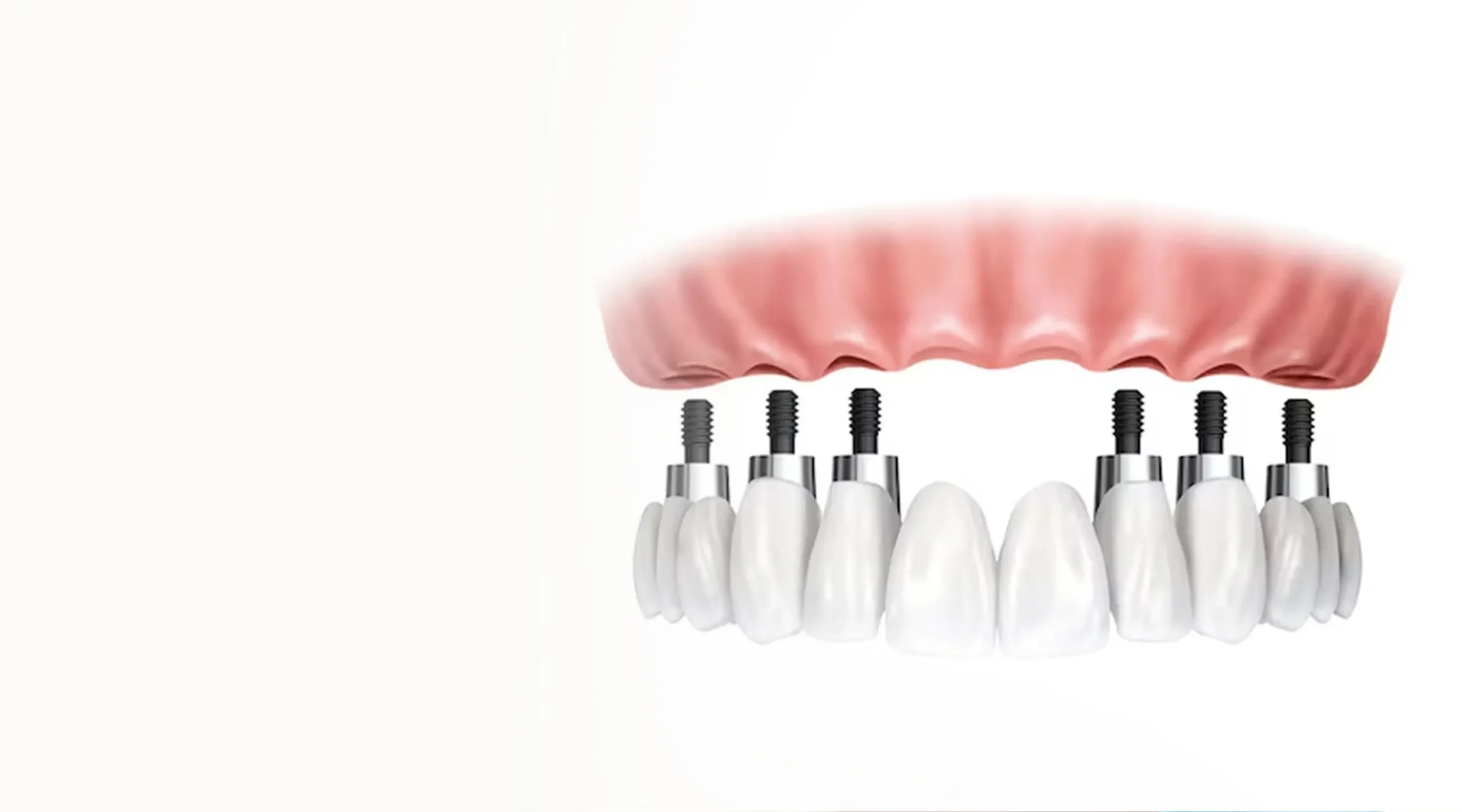 All-on-6 Implants