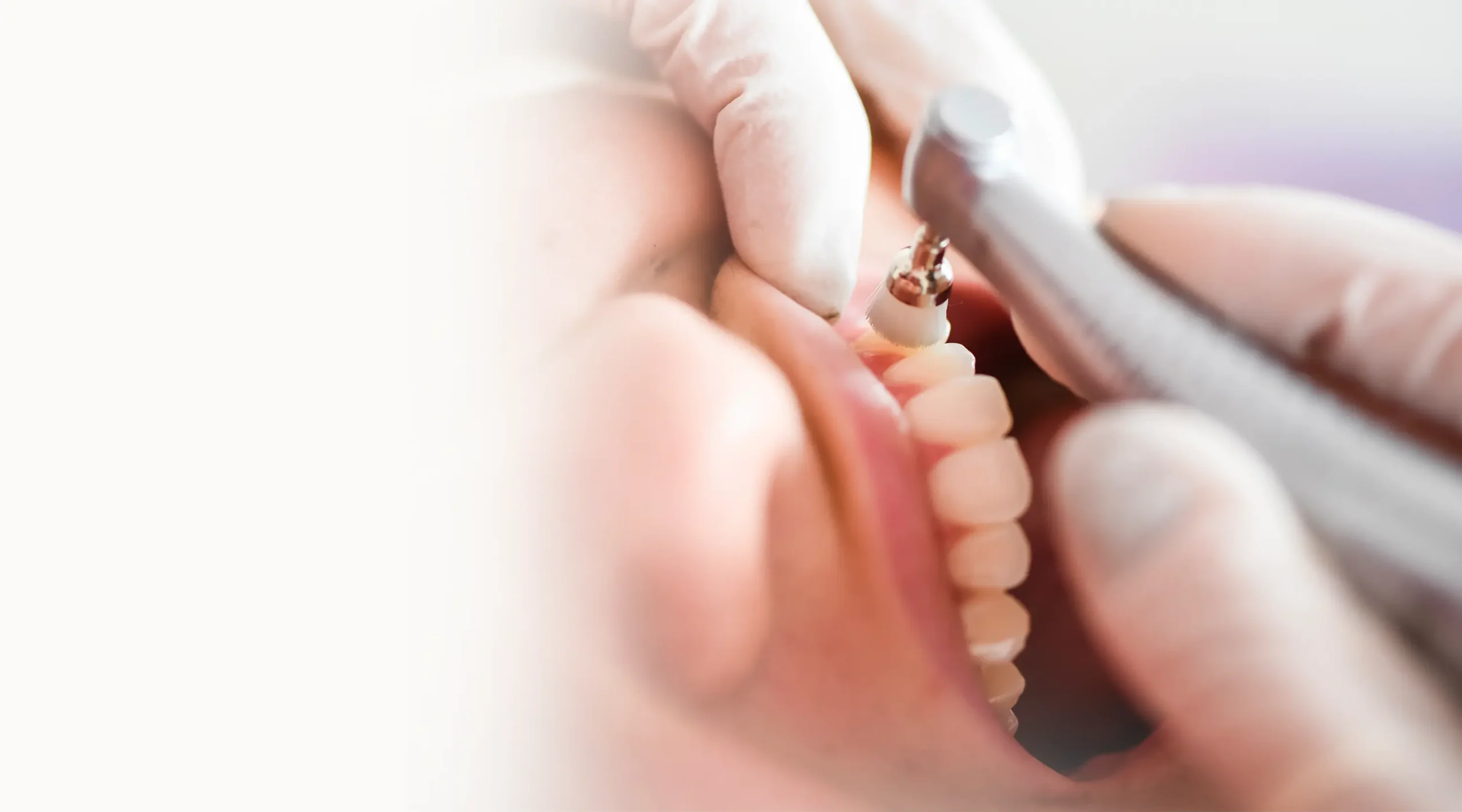 Teeth Cleaning