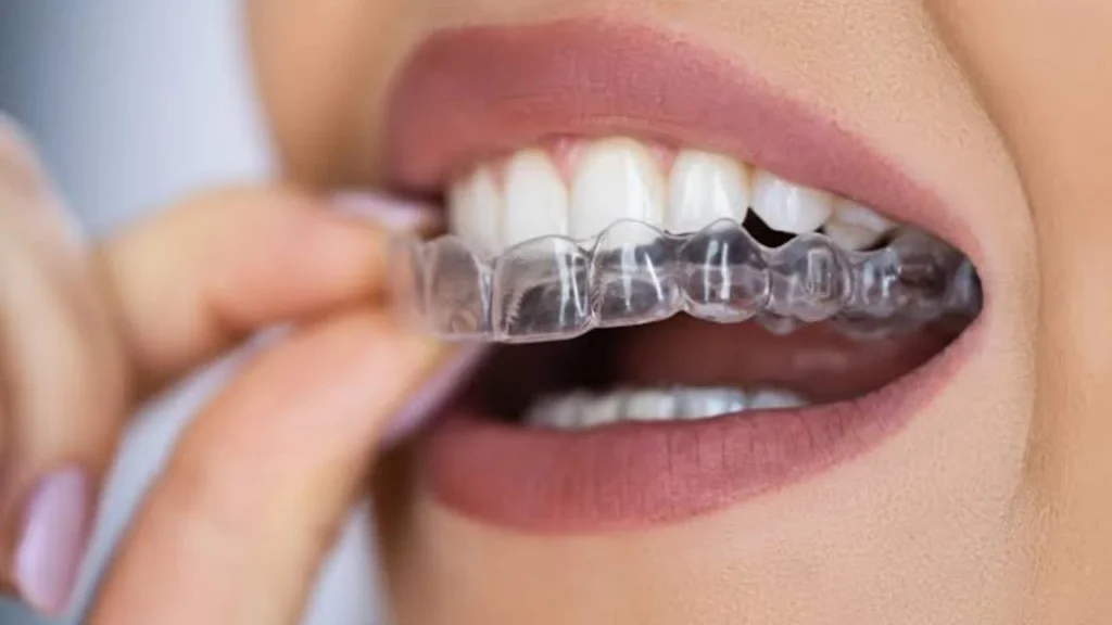 Allineatori trasparenti se vivete all’estero: come funziona il trattamento