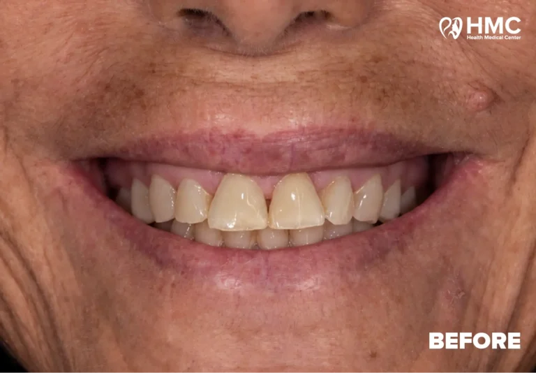 Para Hollywood smile në Tiranë – dhëmbët e Lauretanës, të konsumuar, të verdhë dhe të parregullt