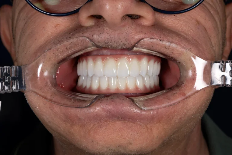 Después del All-on-4 en ambos maxilares – los nuevos dientes completos y uniformes de Michele